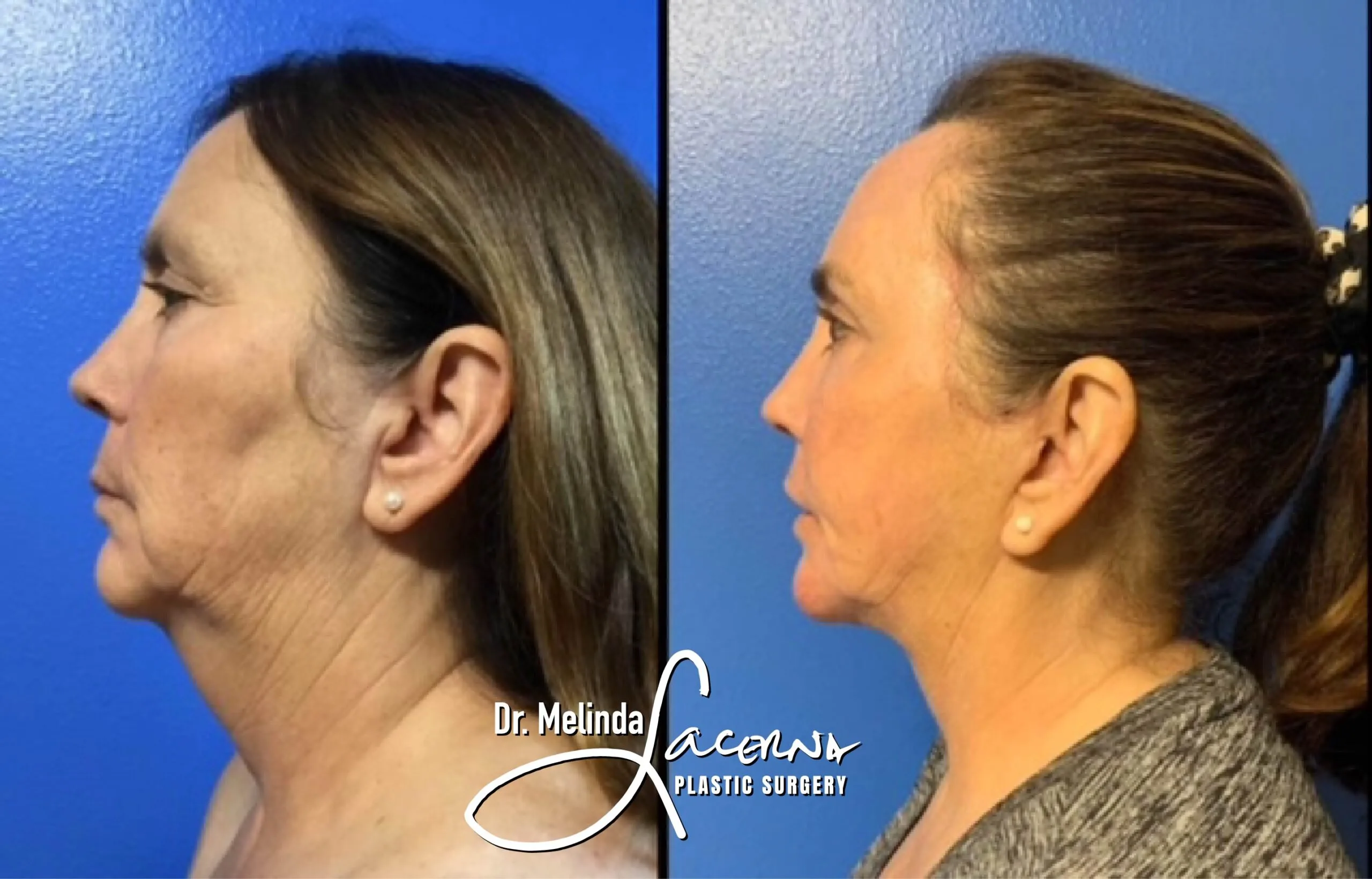Facelift 13