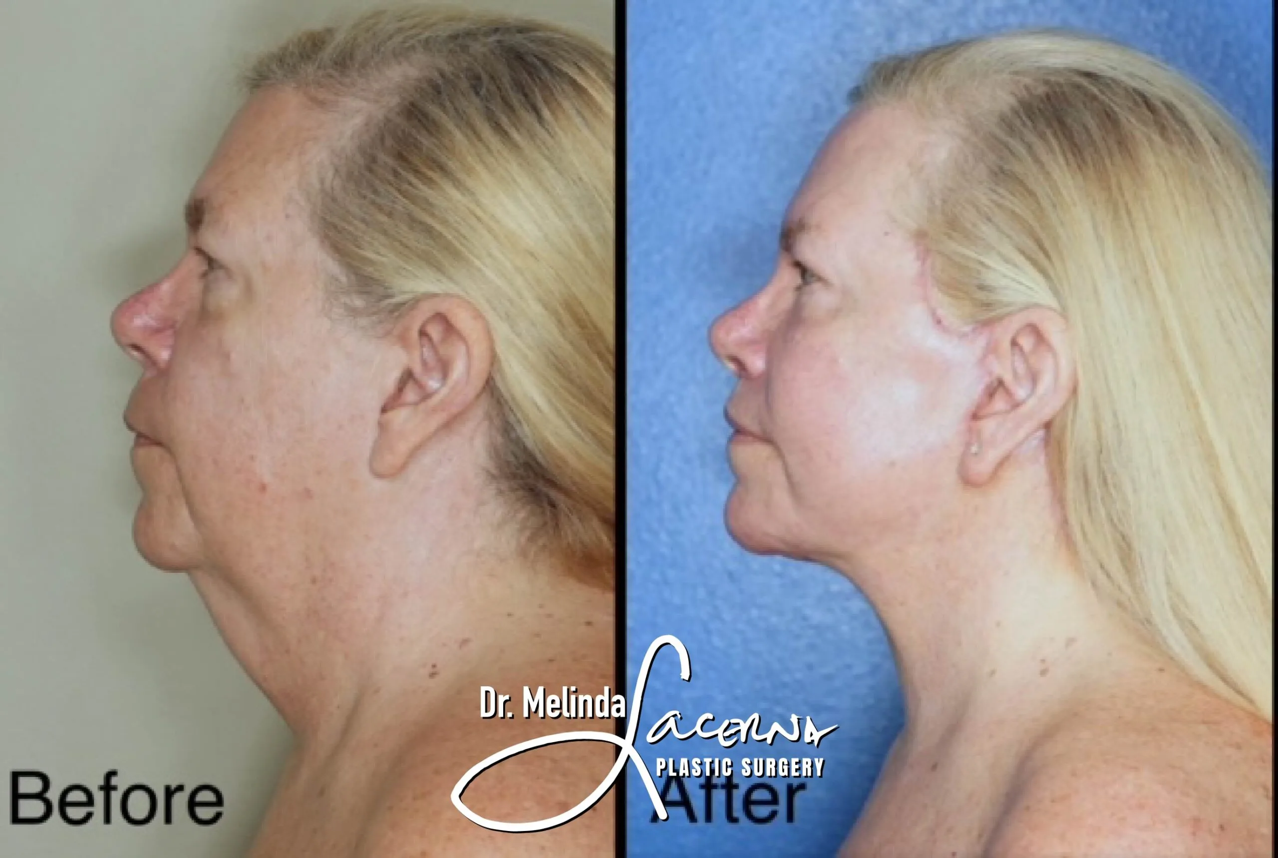Facelift 15.1