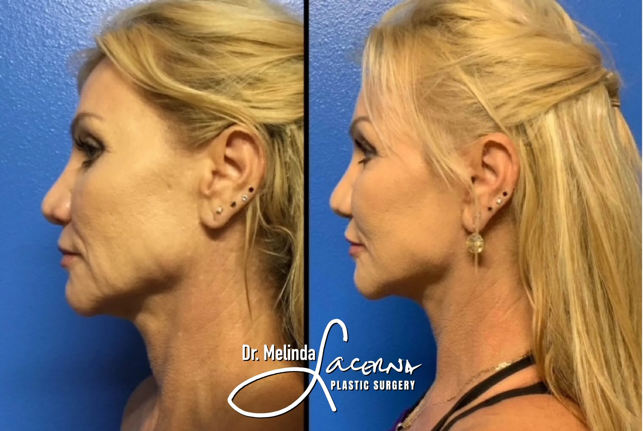Facelift 16.1