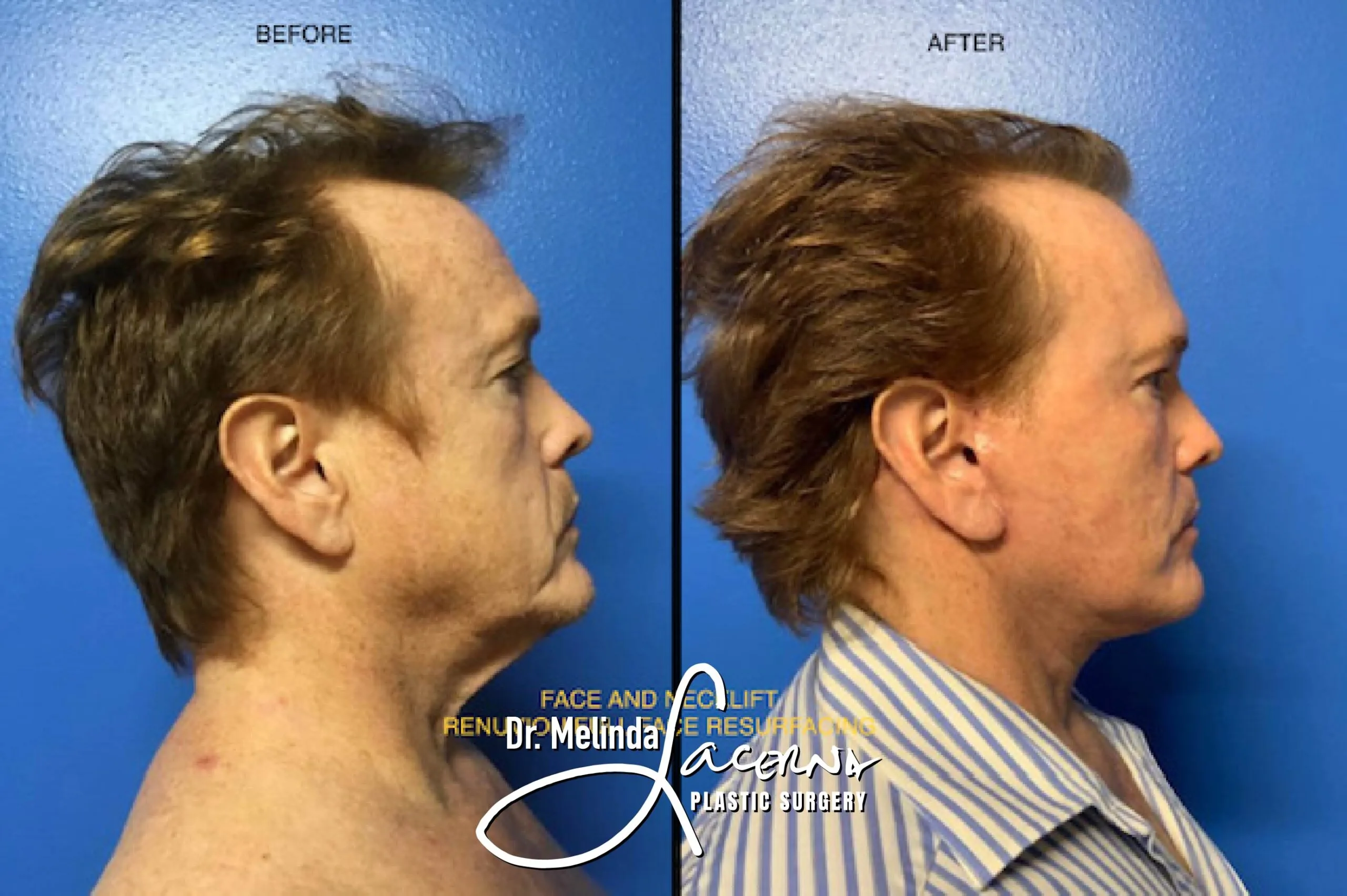 Facelift 3