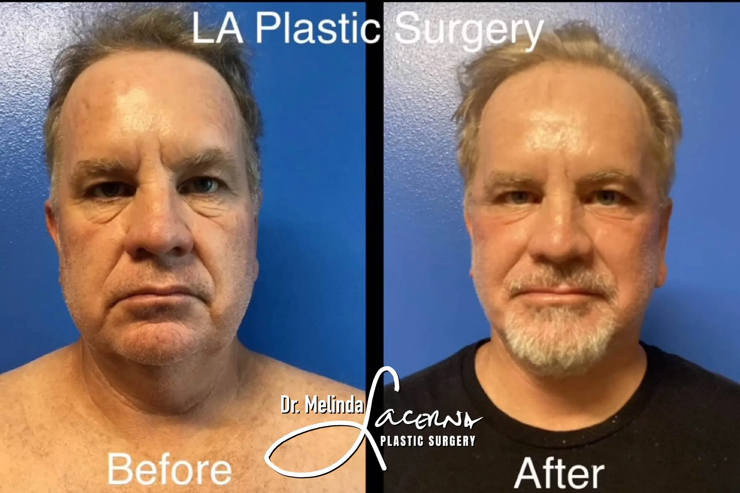 Facelift 5.1