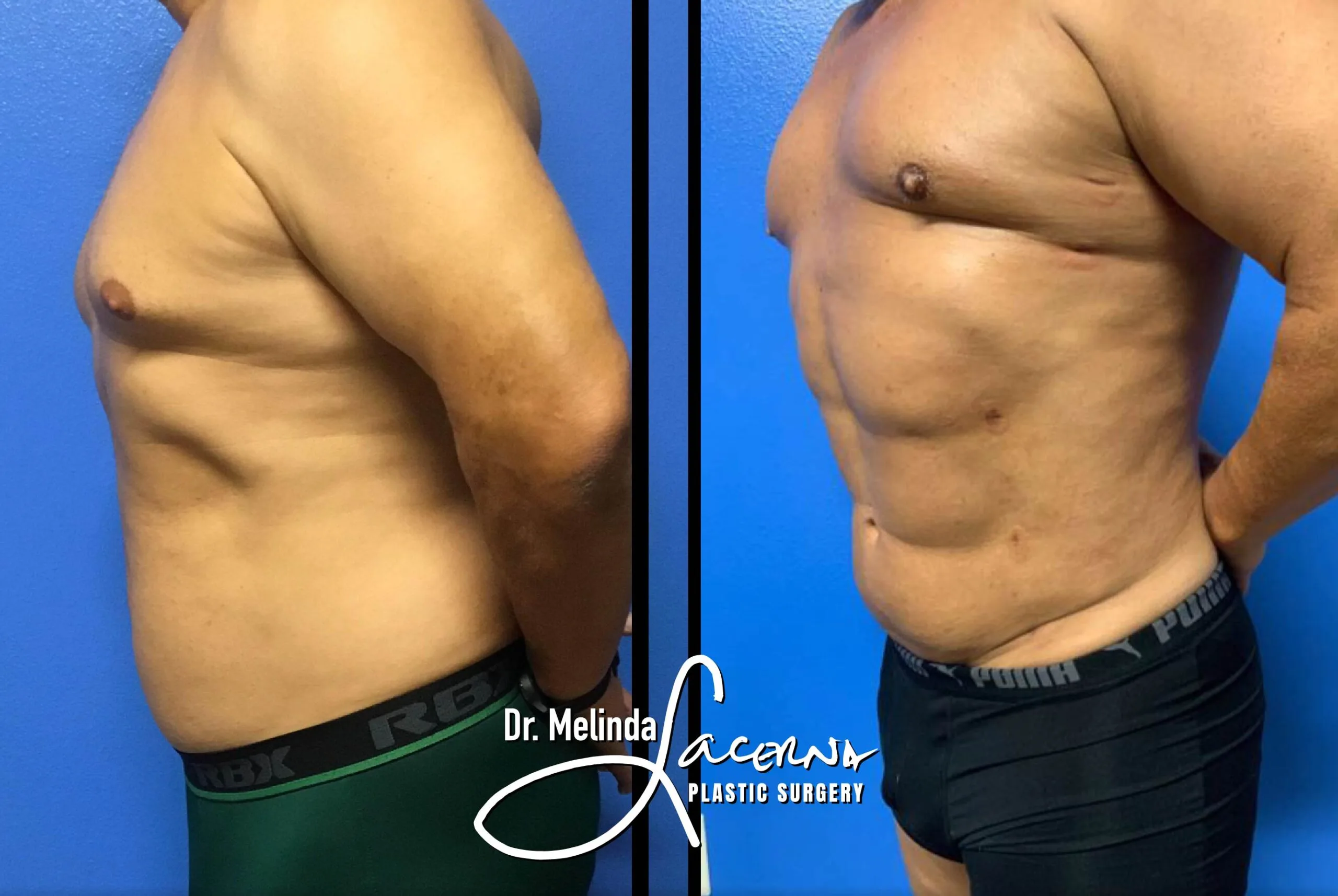 Liposuction 1.2