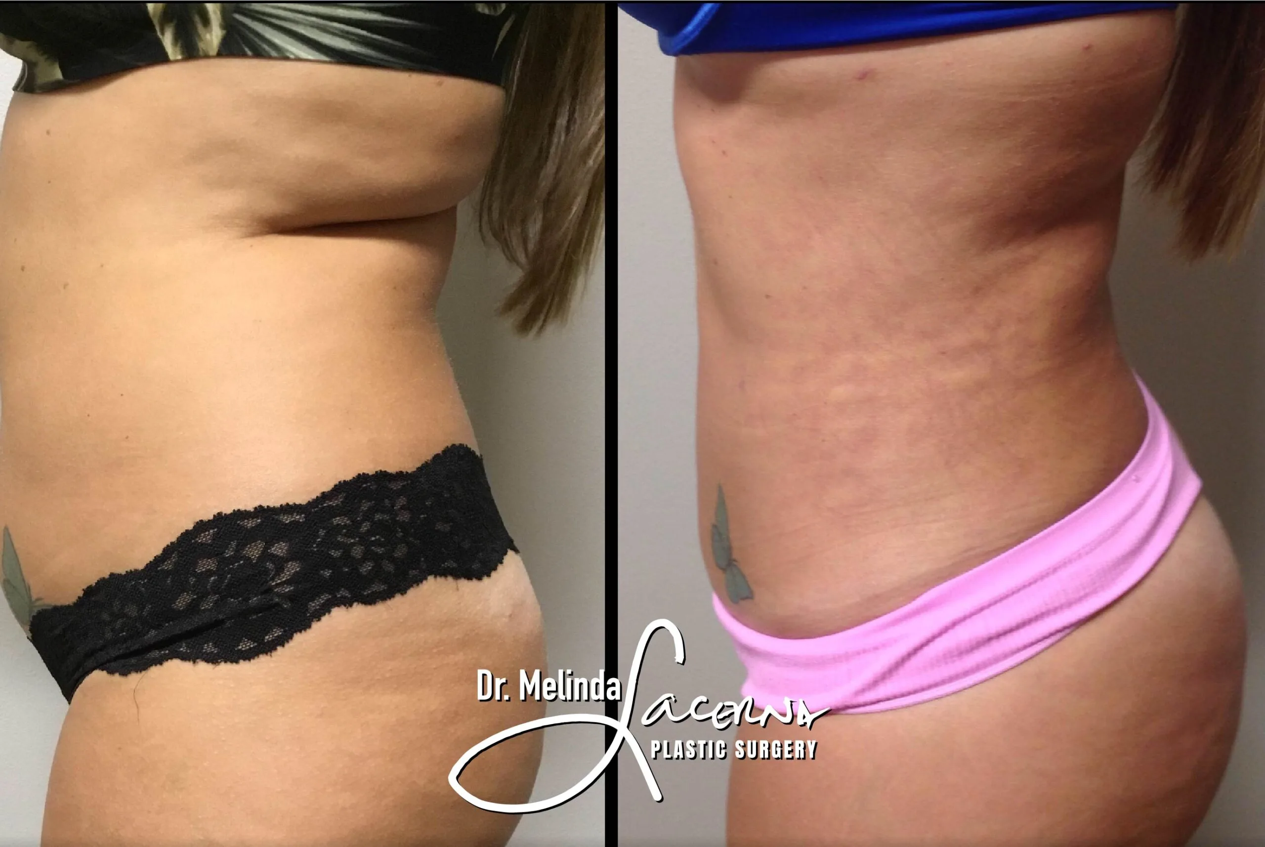 Liposuction 2.1
