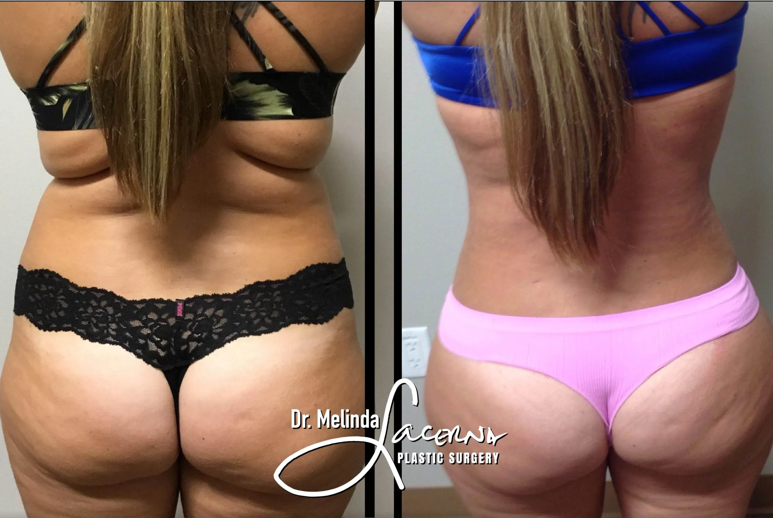 Liposuction 2