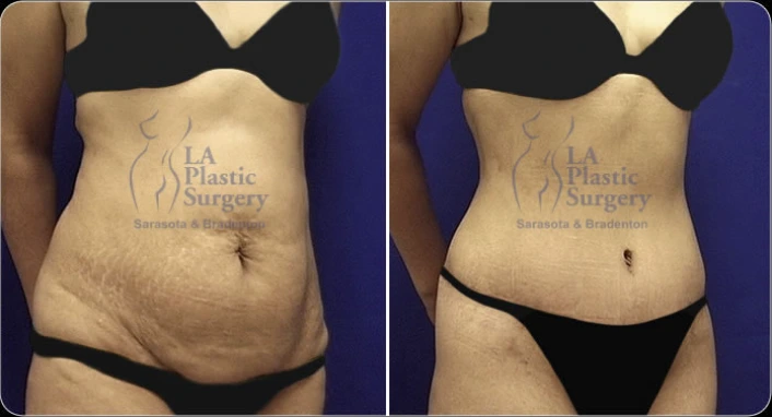 Before and after liposuction of abdomen showing reduced belly fullness and improved abdominal definition