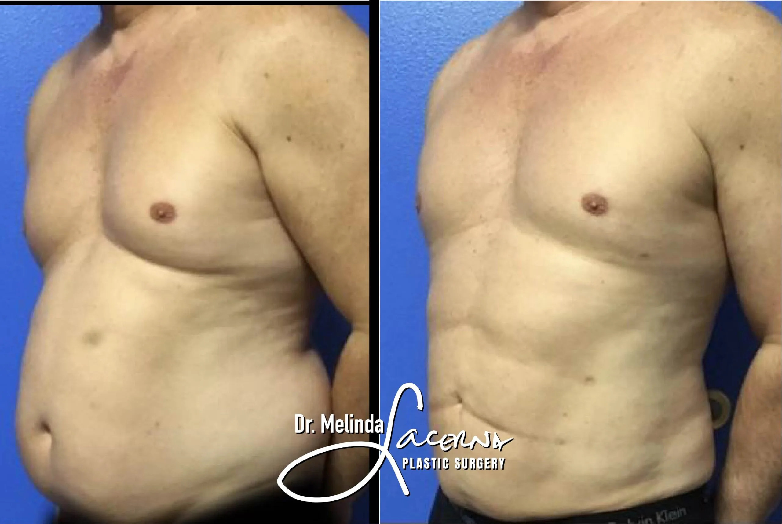 Liposuction 9
