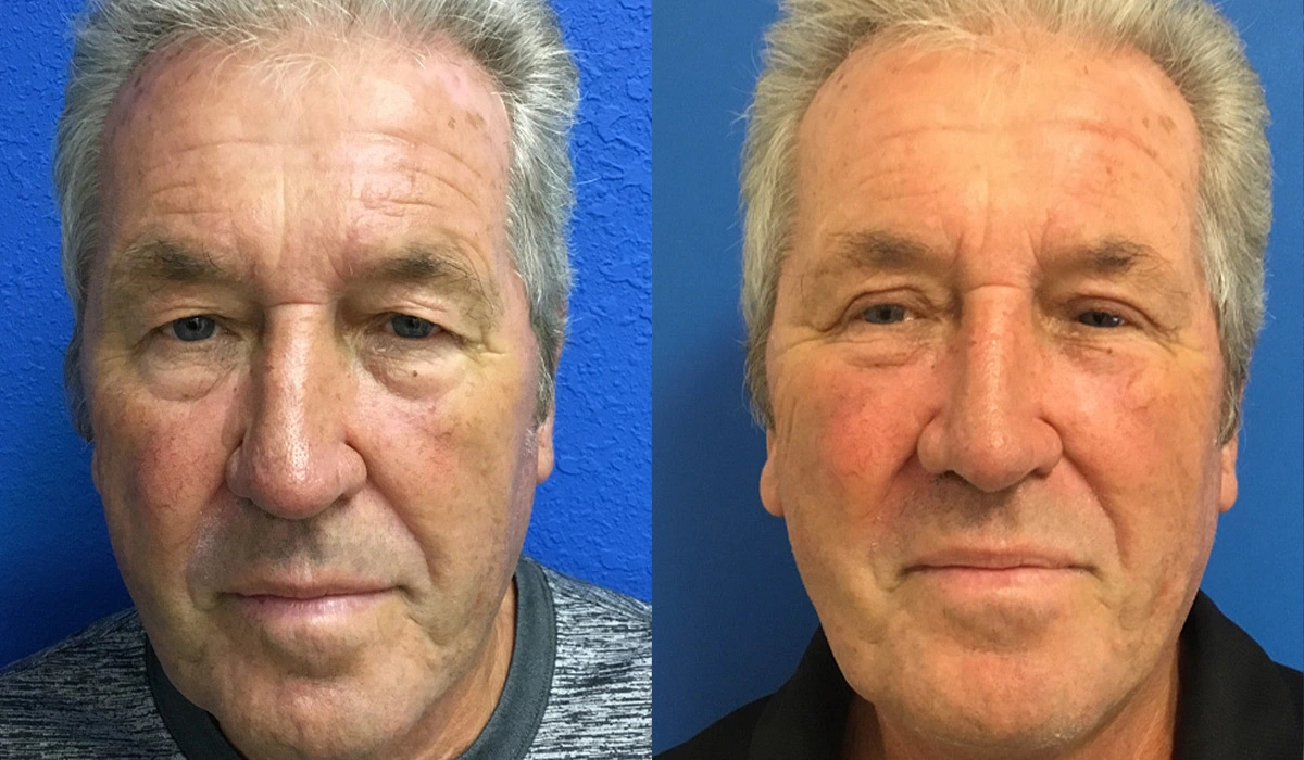 Rhinoplasty 2