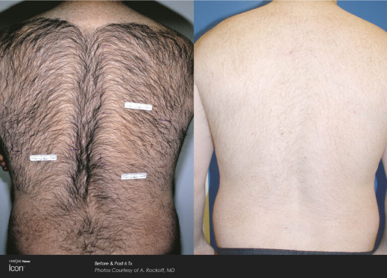Laser Hair Removal in Bradenton, FL Banner