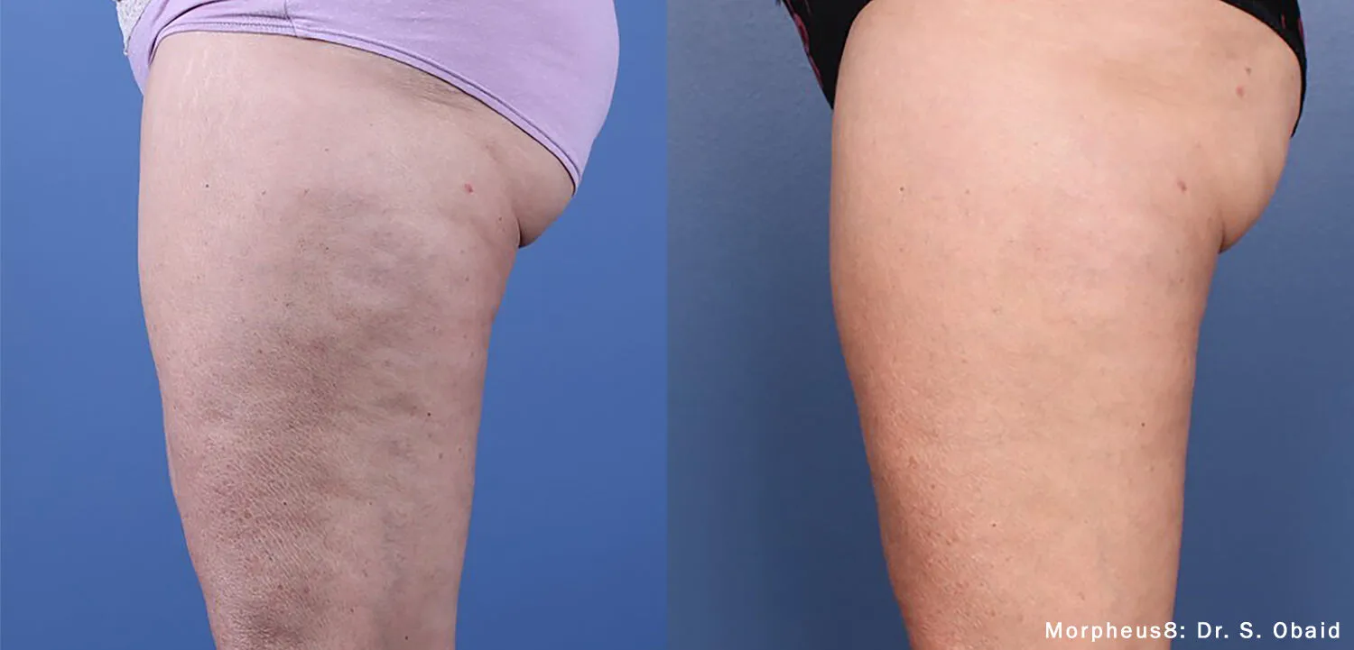 Morpheus8 Body clinical before and after: smoother skin on the back of the thigh (manufacturer photo)