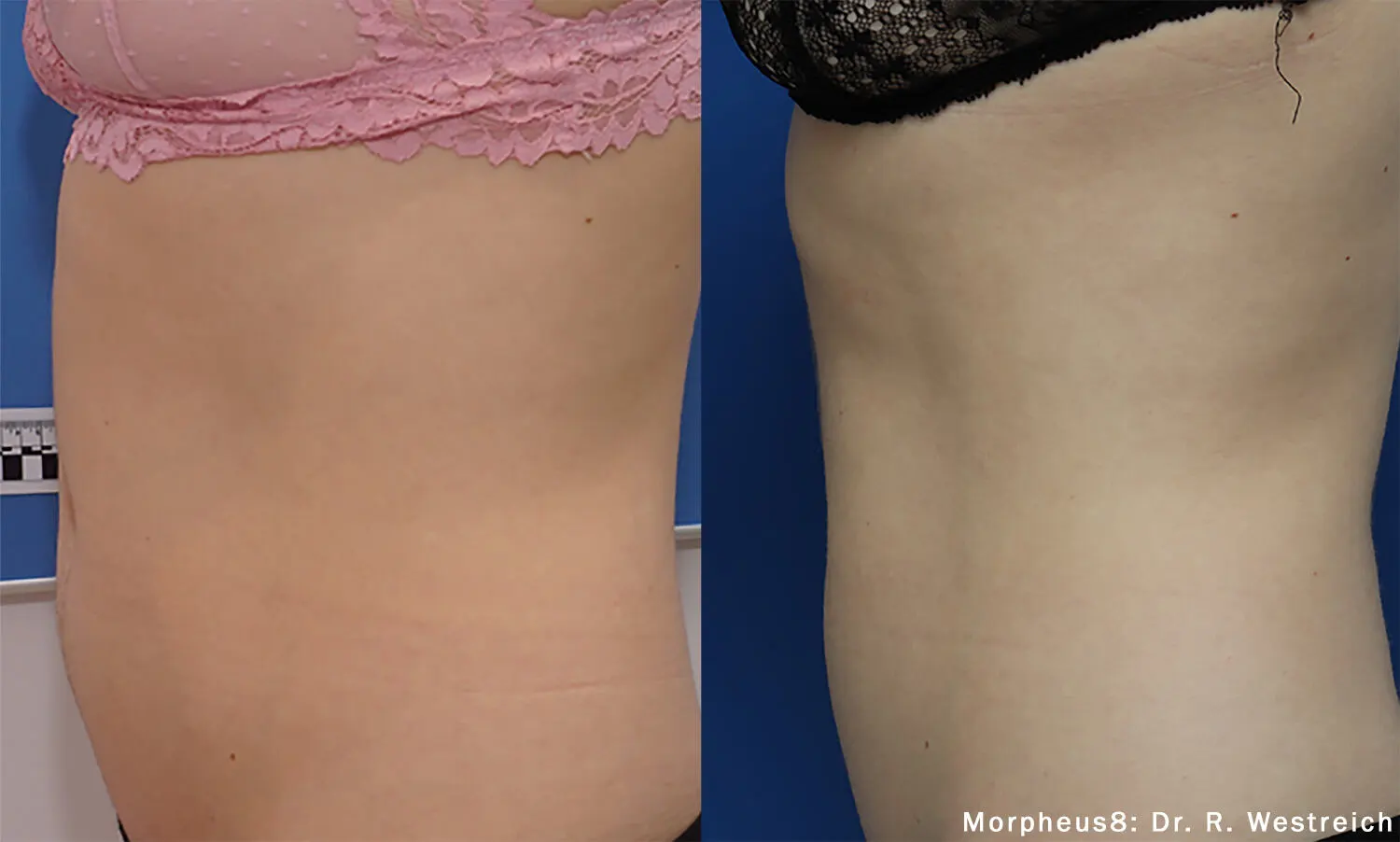 Morpheus8 Body clinical before and after: tighter skin on the abdomen (manufacturer photo)