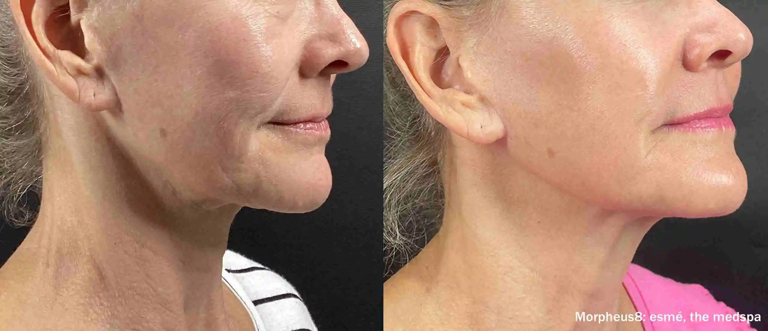 Morpheus8 clinical before and after: a firmer jawline and neck (manufacturer photo)