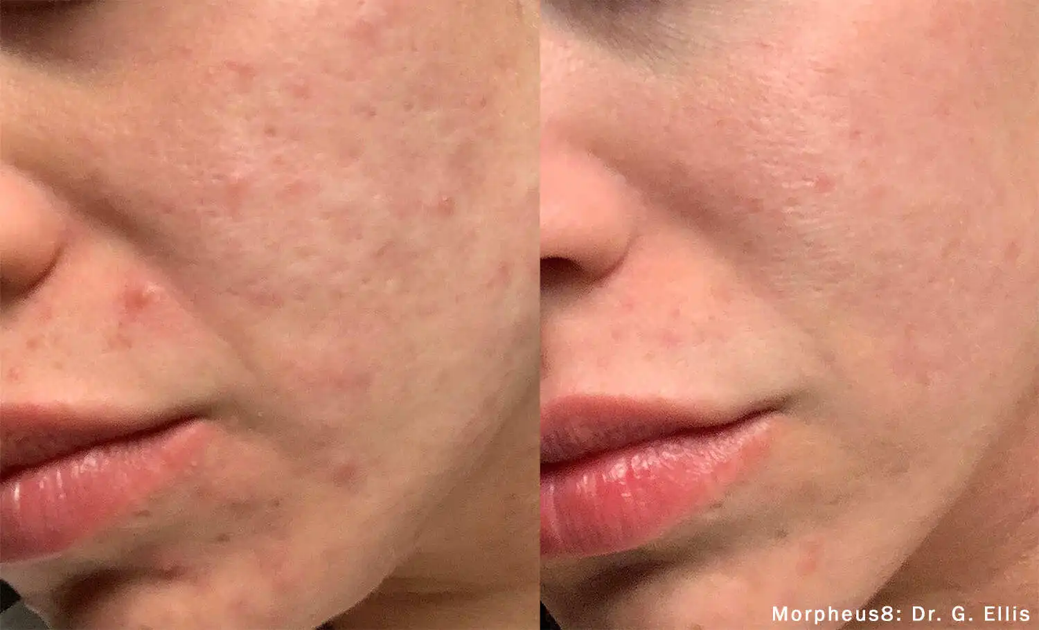 Morpheus8 clinical before and after: clearer cheek skin with smoother texture (manufacturer photo)