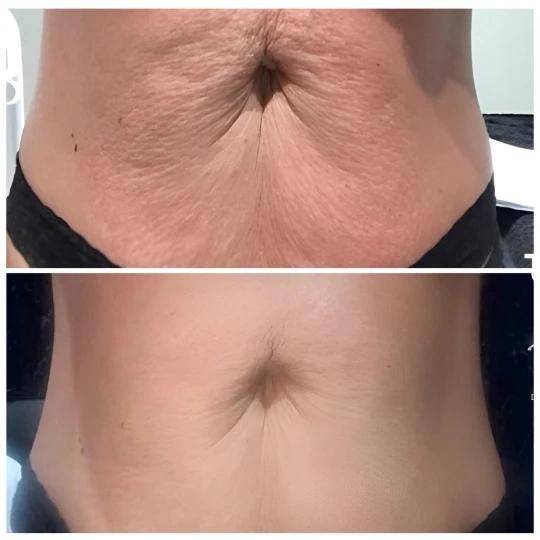 T-Shape 2 clinical before and after: smoother, firmer skin on the abdomen (manufacturer photo)
