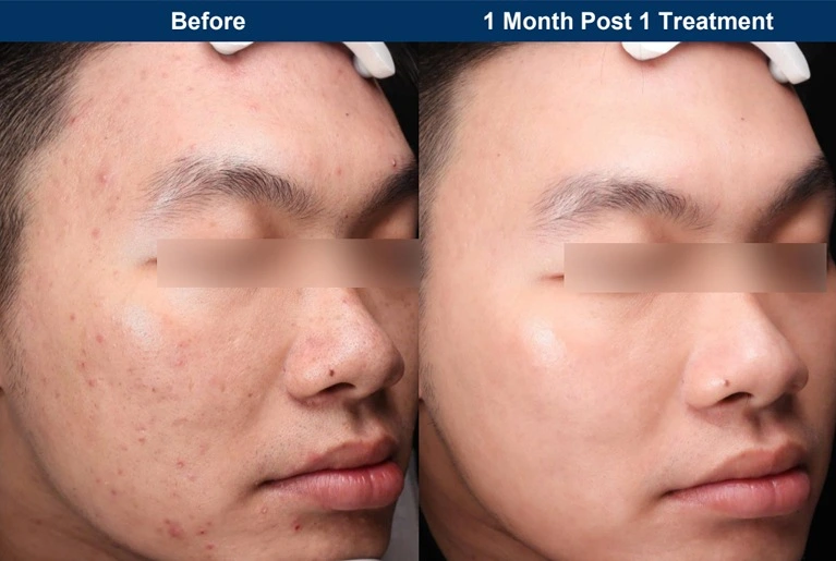 UltraClear clinical before and after, one month after one treatment: clearer acne-prone skin (manufacturer photo)