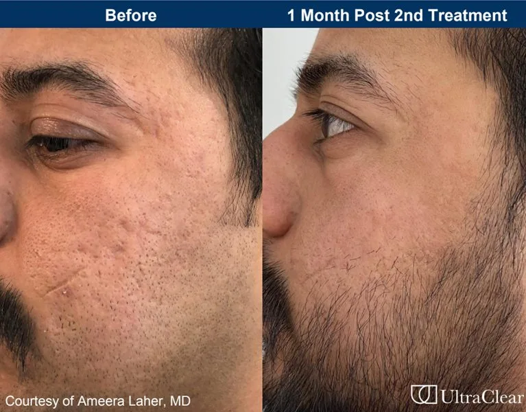 UltraClear clinical before and after, one month after a second treatment: smoother acne scarring (manufacturer photo)