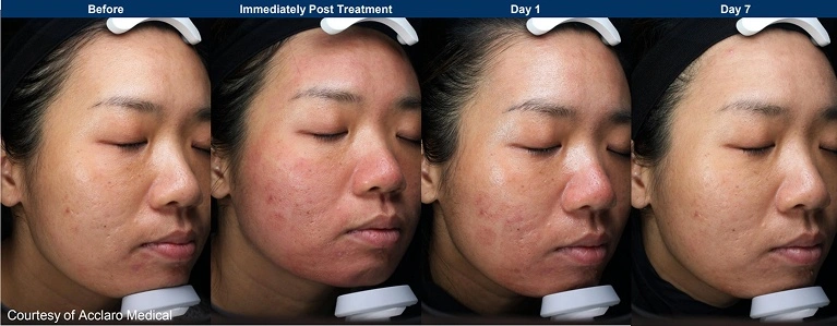 UltraClear clinical photos before, right after, day 1 and day 7 of treatment (manufacturer photo)