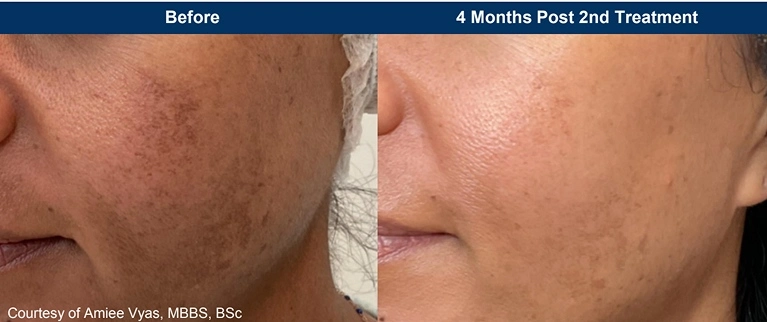 UltraClear clinical before and after, four months after a second treatment: lighter hyperpigmentation on the cheek (manufacturer photo)