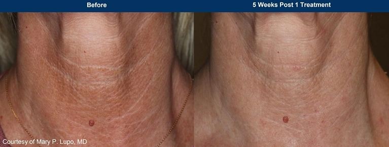 UltraClear clinical before and after, five weeks after one treatment: softer fine lines on the neck (manufacturer photo)