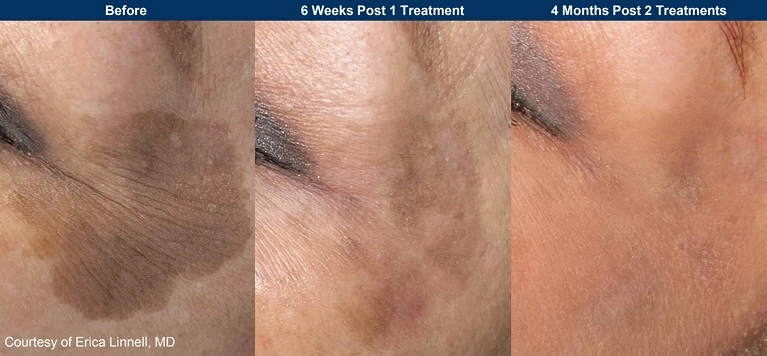 UltraClear clinical before and after: a lighter brown patch after two treatments (manufacturer photo)