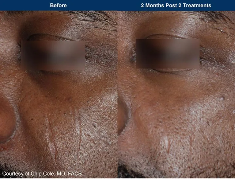 UltraClear clinical before and after, two months after two treatments: a softer scar (manufacturer photo)