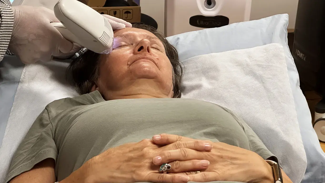 Patient receiving Morpheus8 radiofrequency microneedling treatment to the face at La Réserve Aesthetics