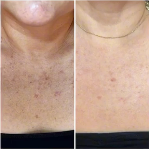 DermaV – Neck and Chest Pigmentation before and after