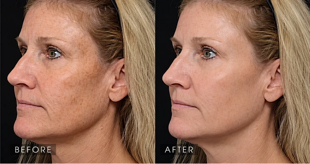 UltraClear – Side Profile before and after