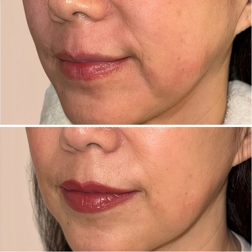 Sofwave and Neurotoxin – Lower Face before and after