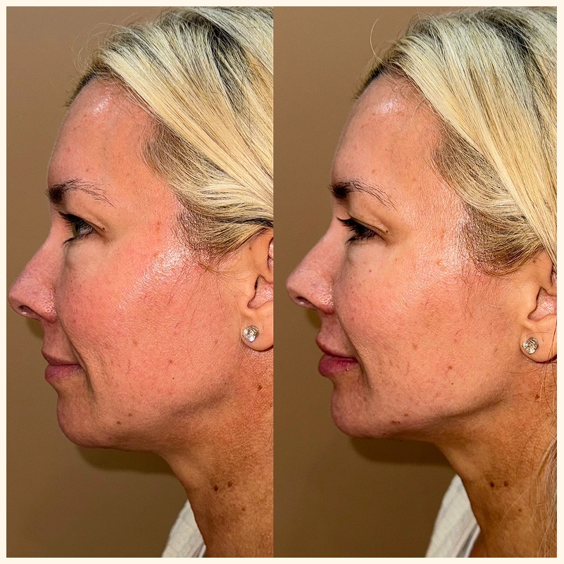 Neurotoxins – Side Profile before and after