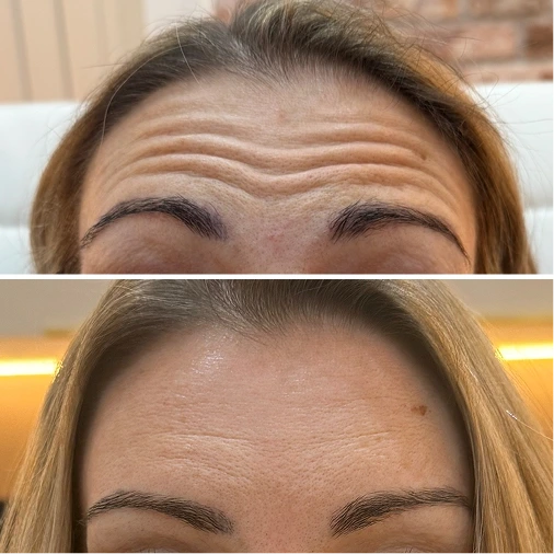 Neurotoxins – Forehead Lines before and after
