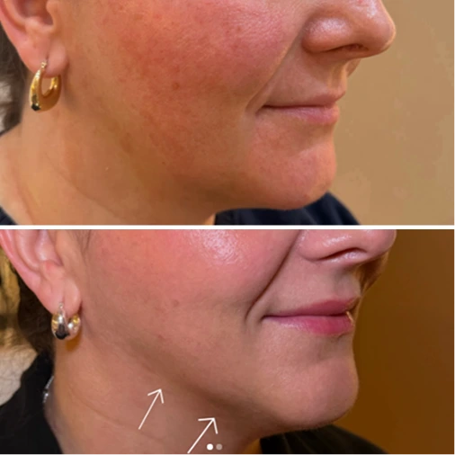 Neurotoxins – Jawline before and after