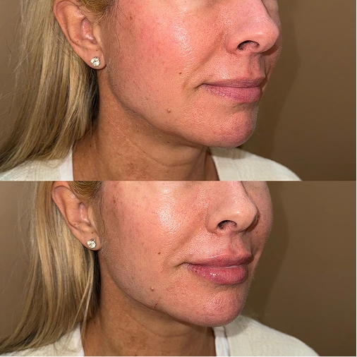 Neurotoxins – Lower Face before and after