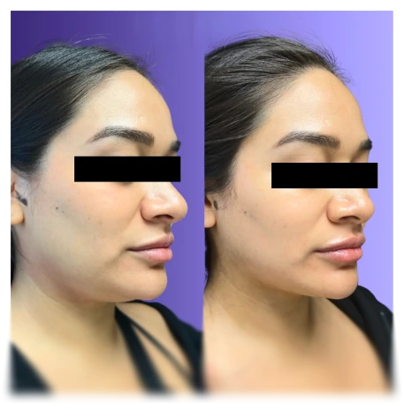Before and after profile view showing facial skin texture improvement