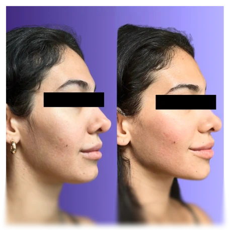 Before and after side profile demonstrating skin refinement results