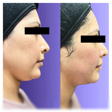 Before and after side profile comparison of facial contours and definition