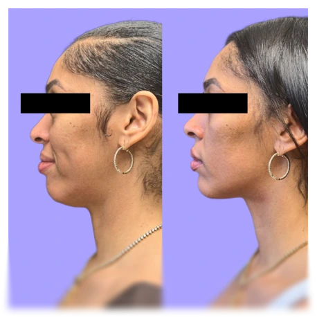 Before and after side profile demonstrating facial contouring results