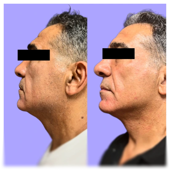 Before and after side profile showing facial definition and contour improvement