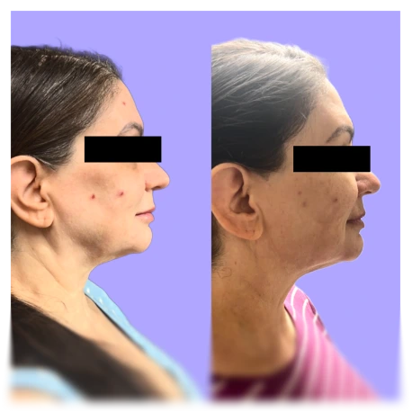 Before and after side profile showing jaw and chin definition enhancement