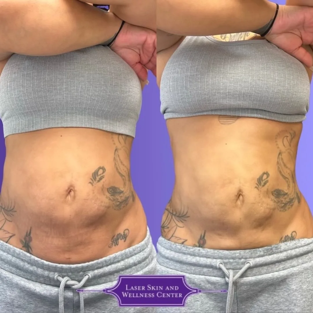 Before and after abdominal area showing reduced appearance of stretch marks and improved skin texture