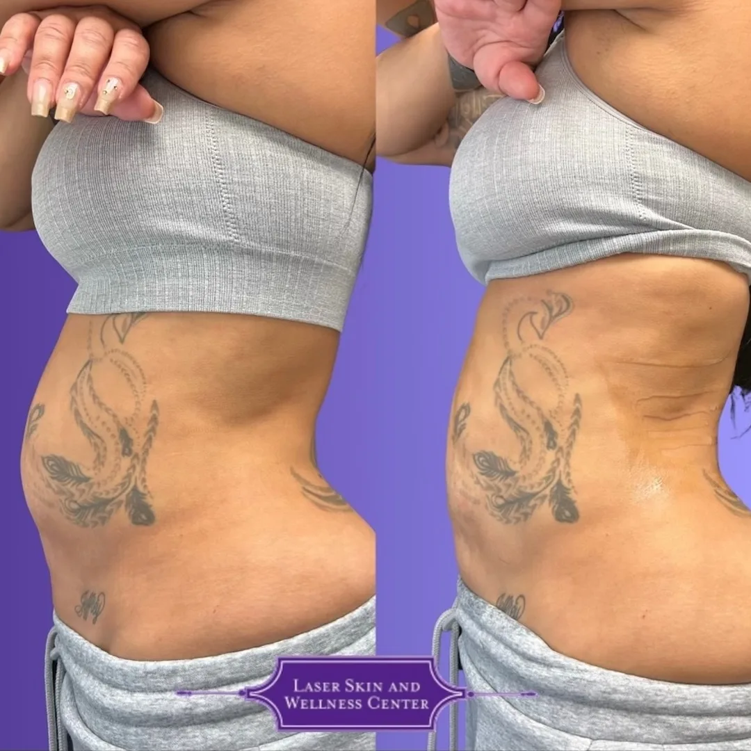 Before and after side view of torso showing skin tightening and reduced laxity