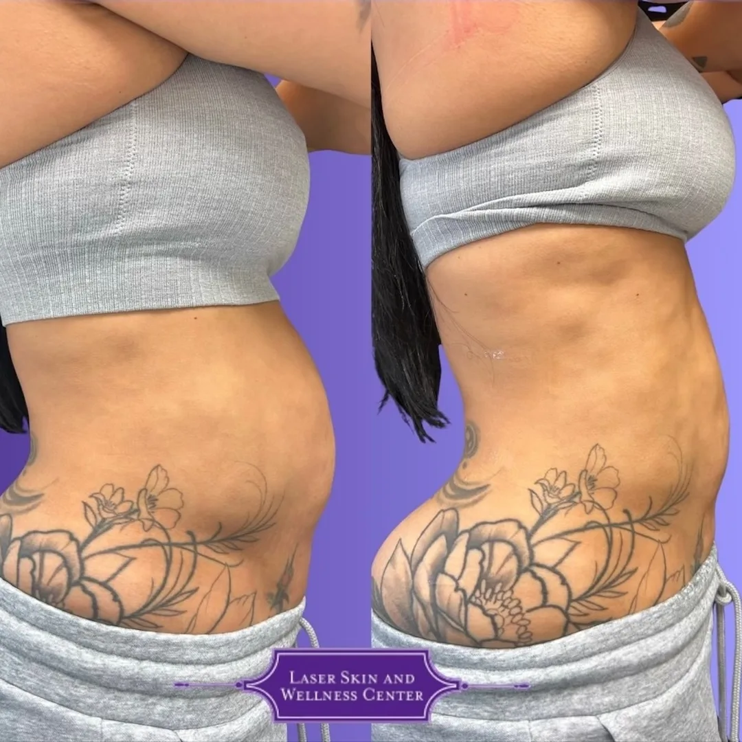 Before and after side view of lower abdomen and hip area showing improved skin appearance
