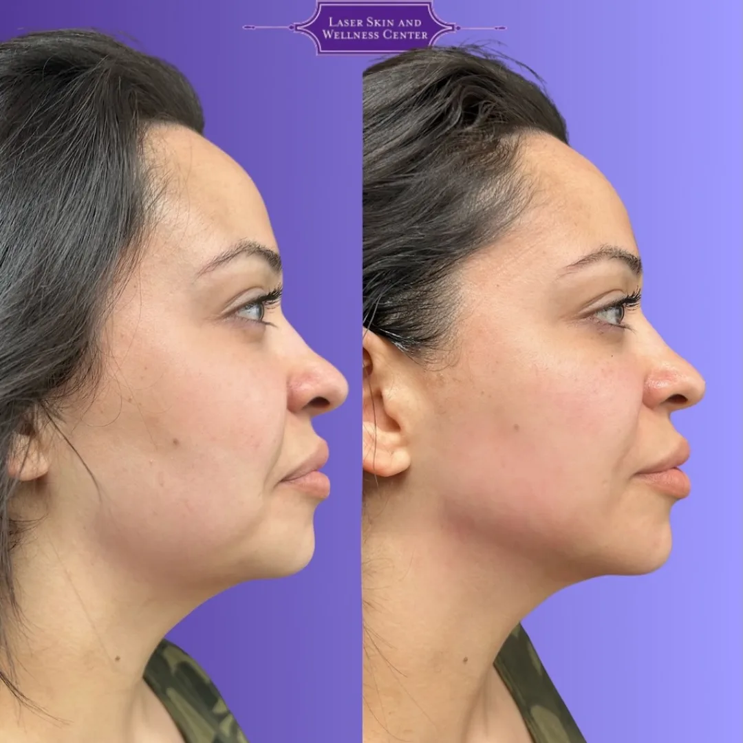 Before and after profile view of face showing improved skin texture and definition