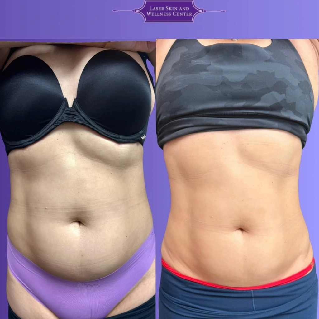 Before and after liquid lipo treatment showing reduced abdominal fullness and improved definition