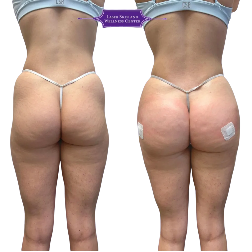 Before and after comparison of non-surgical BBL treatment showing gluteal enhancement from back view with Laser Skin and Wellness Center logo
