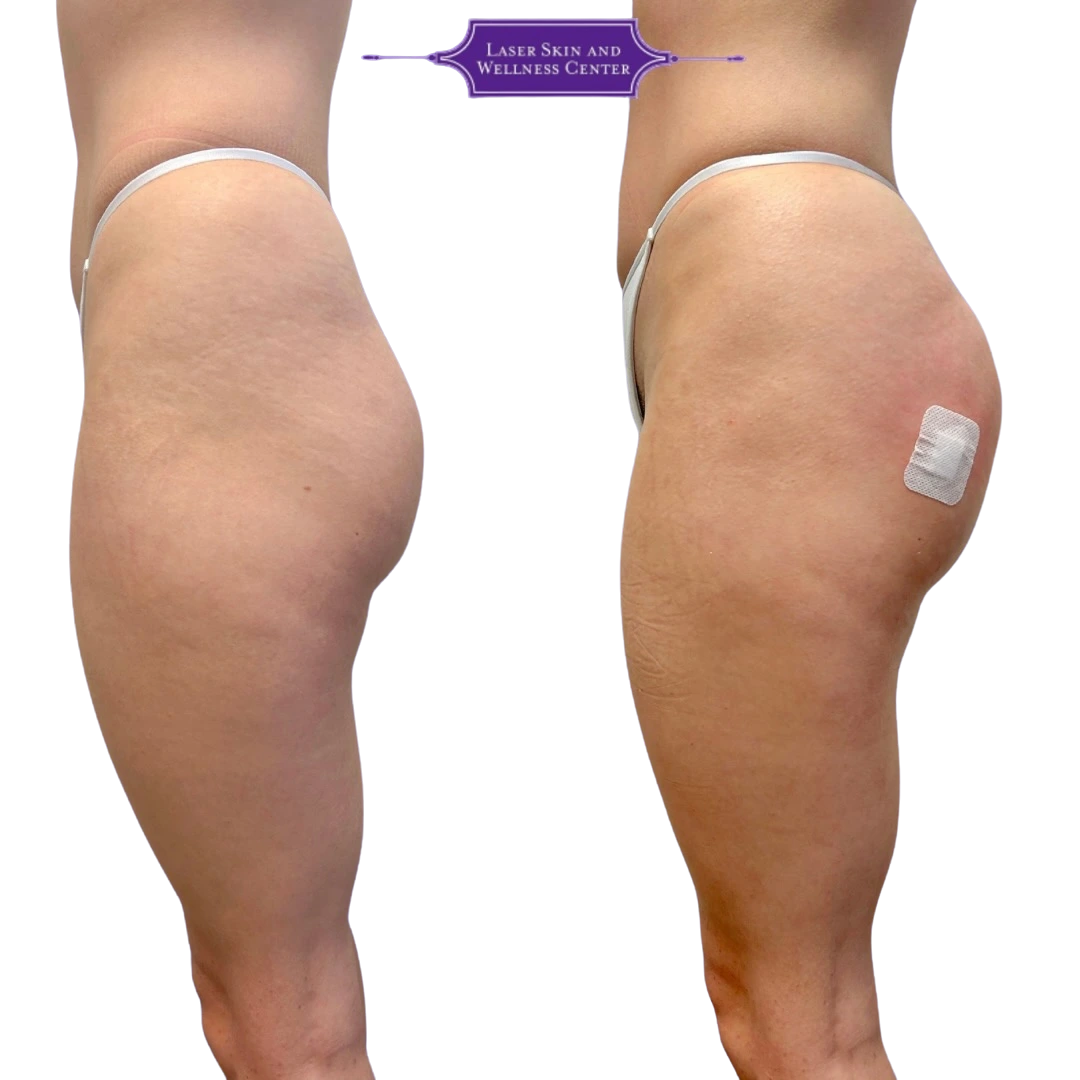 Side profile comparison of buttock augmentation showing improved shape and fullness