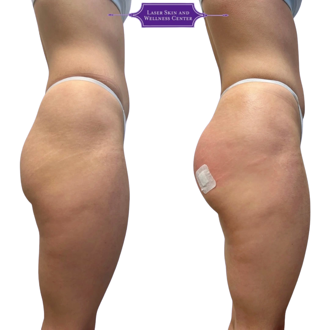 Side-by-side buttock enhancement results from lateral angle demonstrating increased projection