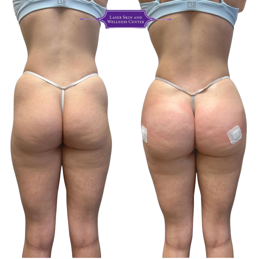 Before and after comparison of non-surgical BBL treatment showing gluteal enhancement from back view with Laser Skin and Wellness Center logo