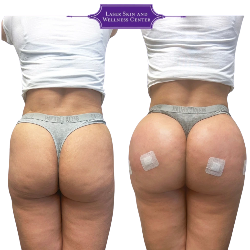 Before and after buttock augmentation, rear view showing enhanced volume and lifted contour