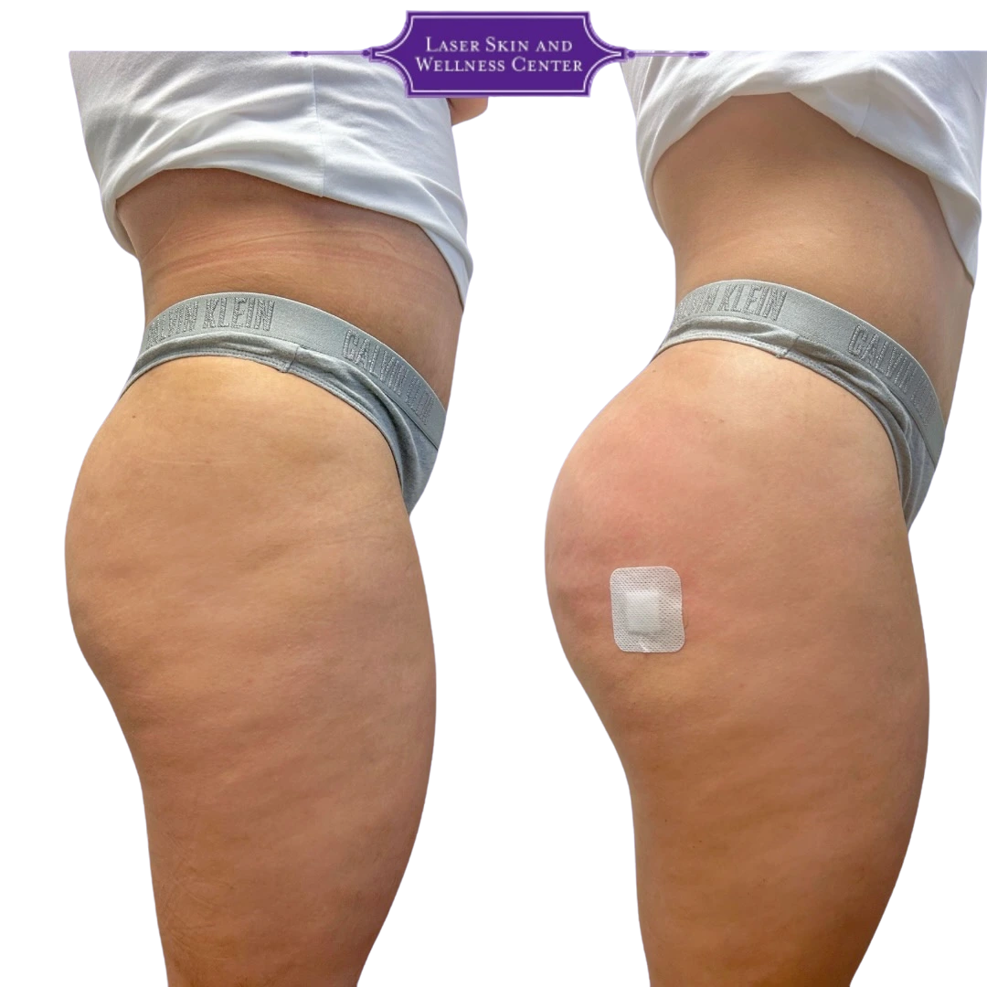 Before and after side view of buttocks with enhanced projection and shape