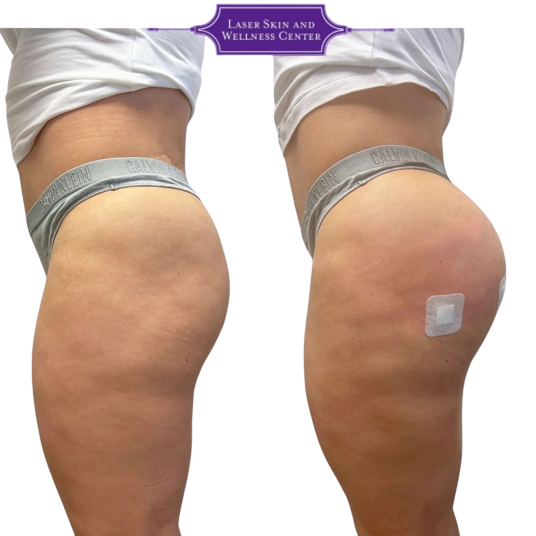 Side profile buttocks before and after showing increased volume and lift